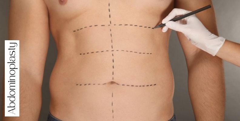 Abdominoplastia