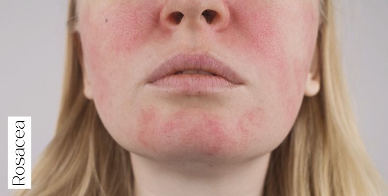 rosacea